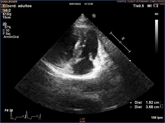 Figura 6. Ecocardiografía de la recidiva. Corte longitudinal izquierdo de tres cámaras optimizado para ver tracto de entrada ventricular derecho. Se observa una masa que abarca pared libre atrial derecha y ventricular derecha, de ecogenicidad mixta, de 1.92 cm de anchura mínima.