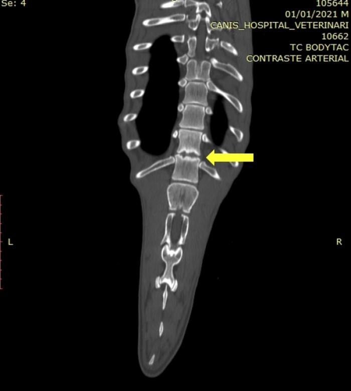 Figura 4. Tomografía computarizada en plano dorsal de la columna, donde se observa una lesión compatible con discospondilitis entre T12-T13 (flecha).