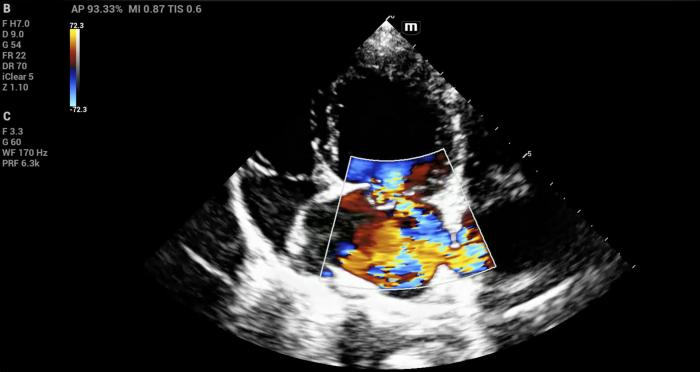 Figura 15. Reflujos mitral severo en paciente con endocardiosis mitral. Vista apical izquierda de 4 cámaras.