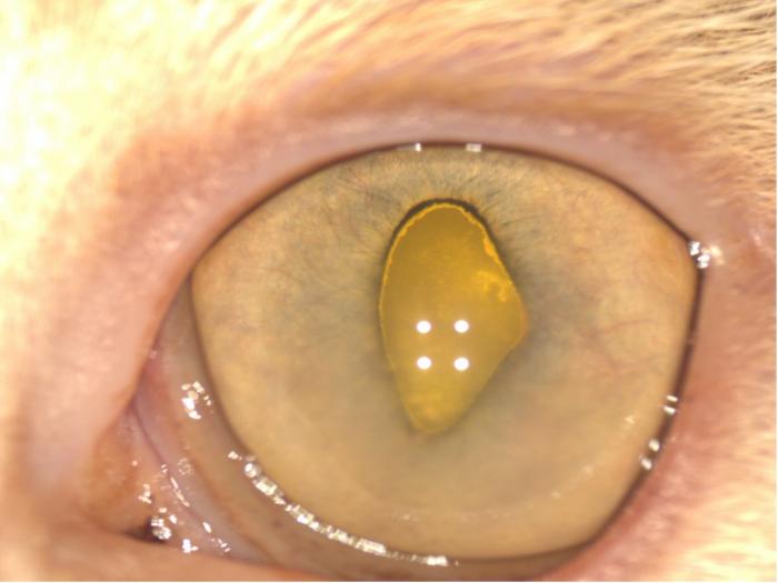 Figura 1. (A) OS con discoria, rubeosis, edema corneal y Tyndall. (B) OS, detalle de los precipitados queráticos.