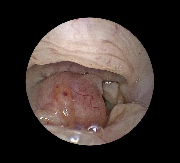 Figura 3. Sialocele en paciente felino responsable del desplazamiento medial del cartílago aritenoides derecho con obstrucción del vestíbulo laríngeo. Candidato a maniobra de entubación asistida.   