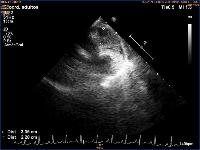 Figura 5. Ecocardiografía a las 3 semanas de la primera dosis de quimioterapia. Corte longitudinal izquierdo de tres cámaras optimizado para ver tracto de entrada ventricular derecho. Se observa una masa que abarca pared libre atrial derecha y ventricular derecha, de ecogenicidad mixta, de 3.35 cm x 2.28 cm de dimensiones mínimas.