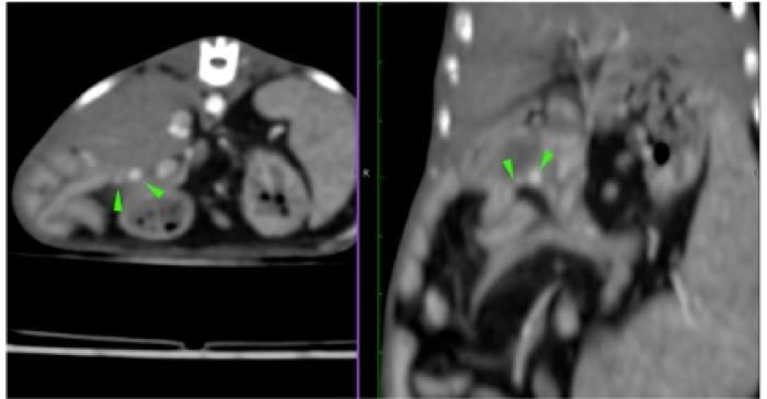 Figura 4. Nódulos de 2.7 y 1.3 mm en fase poscontraste en la base del lóbulo derecho del páncreas en hurón sospechoso de insulinoma.