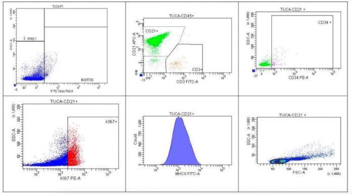 Figura 4. Resultados del imnunofenotipaje de la sangre periférica mediante citometría de flujo compatible con leucemia linfocítica crónica de células B.