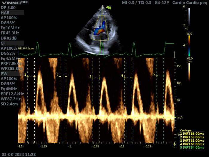 Figura 12. Ecocardiografía Doppler en un gato con HCM. Proyección paraesternal izquierda apical 5 cámaras. Doppler pulsado a nivel del tracto de salida del VI. Valoración del IVTR en varios puntos.