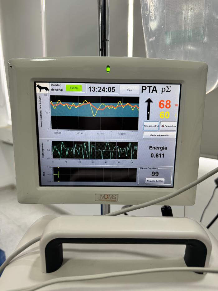 Figura 6.  Imagen donde observamos el predominio de actividad parasimpática durante el procedimiento de lobectomía pulmonar con bloqueos ESP y BPS, lo que nos indica una nula respuesta nociceptiva dura el procedimiento quirúrgico, esto confirma que la analgesia otorgada por los bloqueos es buena.