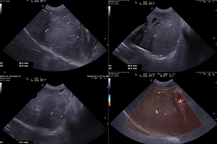 Figura 3. Ecografía hepática donde se identifica una masa levemente hiperecogénica en el lóbulo hepático medio izquierdo, 4.6 x 4 x 4.3 cm (DV x LL x CrCd). En su interior presentaba un área hipoecogénica de márgenes irregulares de 1.4 cm de diámetro. El patrón Doppler no presentaba signos de neovascularización y no se observa efusión peritoneal periférica.