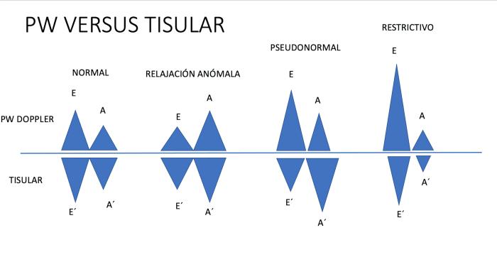 Figura 16. Patrones de llenado ventricular con Doppler pulsado y Doppler tisular.