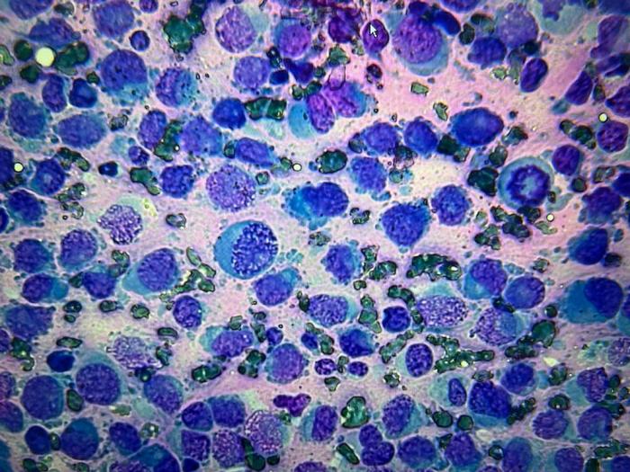 Figura 1. Hiperplasia linfoplasmocitaria debida a un incremento en la presencia de las células linfoides inmaduras y células plasmáticas. También se observa la presencia de células redondas, no linfoides, con atipias evidentes junto con mitosis atípicas abundantes.