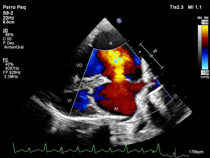 Figura 4. Ecocardiogramas Doppler (A) color y (B, C) espectral obtenidas mediante acceso paraesternal izquierdo apical de 4 cámaras mostrando dilatación severa de las cavidades derechas, regurgitación tricúspide (A, B) y mitral (A, C) y un flujo desde el atrio derecho (AD) hacia el izquierdo (AI) a través del defecto septal. VD, ventrículo derecho; VI, ventrículo izquierdo.