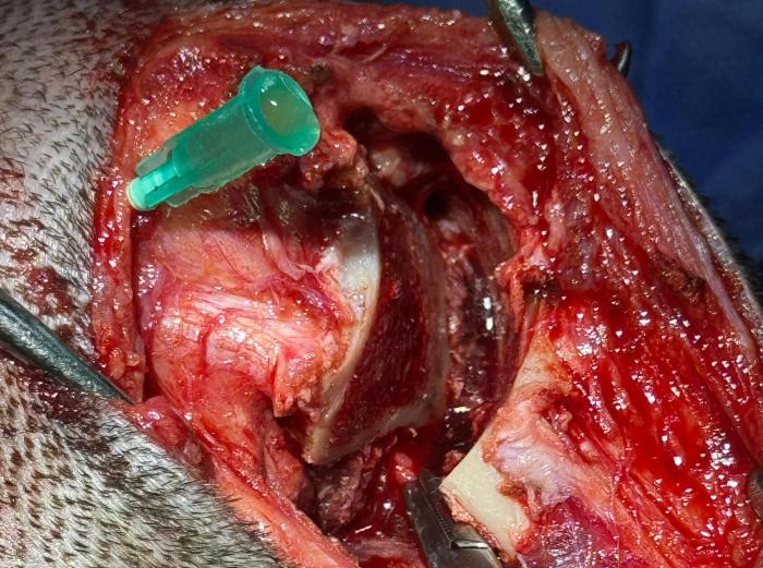 Figura 2. Apertura de osteotomía para mejorar la visualización y clampeado de arteria poplítea próxima a ser ligada.