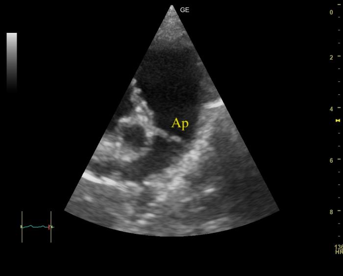 Figura 7. Corte paraesternal derecho eje corto del caso 2 tras 6 meses de terapia con sildenafilo. Se observa una arteria pulmonar (Ap) de dimensiones normales.