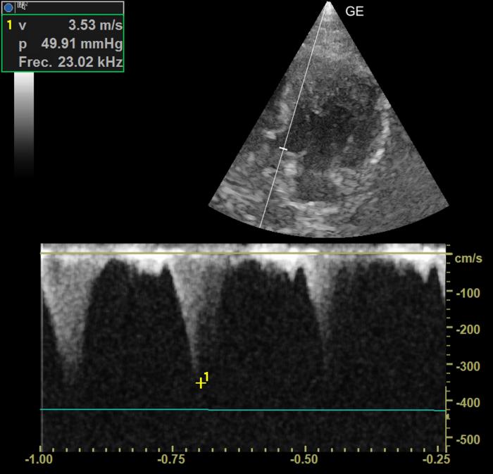 Figura 4. Registro de Doppler continuo a nivel del tracto de salida del ventrículo izquierdo. Morfología de daga e incremento de la velocidad de salida del flujo de eyección aórtico por obstrucción dinámica del tracto de salida del ventrículo izquierdo.