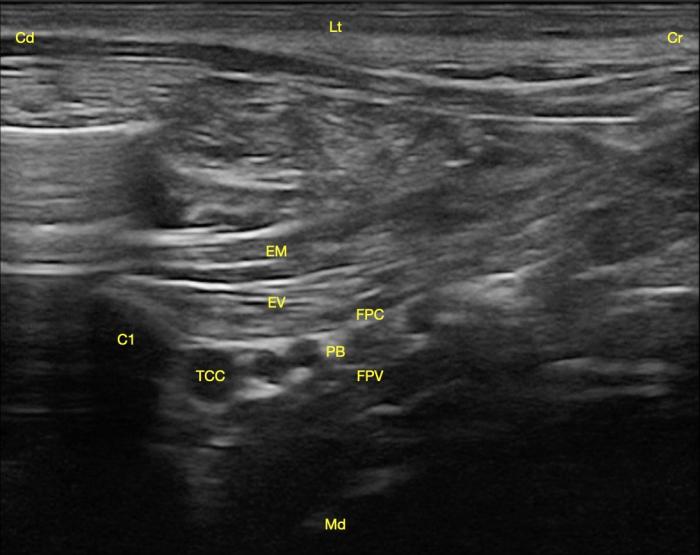 Figura 3. Corte transversal del plexo braquial con abordaje subescalénico. Se observa la primera costilla (C1), los músculos escalenos medio (EM) y ventral (EV), la fascia profunda del cuello (FPC), la fascia prevertebral (FPV) y entre ellas el plexo braquial (PB) junto con el tronco costocervical (TCC). Craneal (Cr), caudal (Cd), lateral (Lt) y medial (Md).