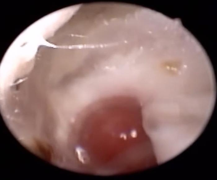 Figura 4A-B. (A) Pólipo en oído izquierdo. (B) Oído derecho. MT transparente que deja ver una masa en el interior de la bulla timpánica. 