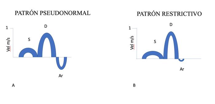 Figura 13. (A) Patrón de venas pulmonares pseudonormal (diastólica dominante) con una onda D con más pendiente y onda Ar alargada. (B) Patrón de venas pulmonares restrictivo con predominancia diastólica, onda D con mucha pendiente y onda Ar muy pequeña.