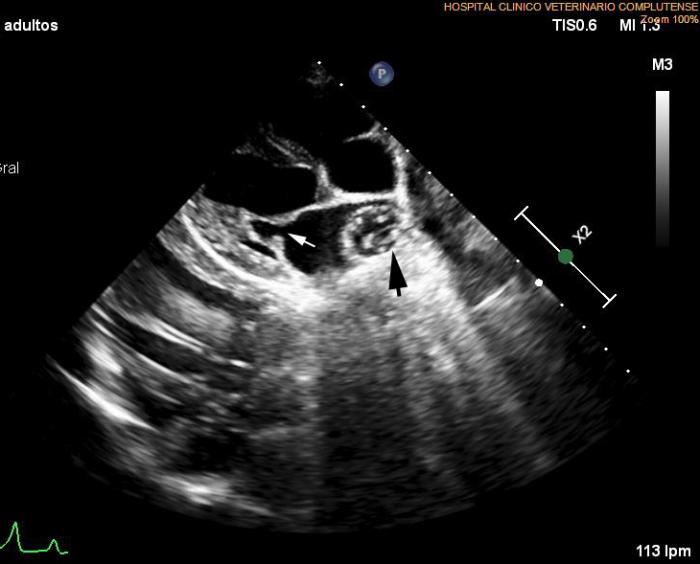 Figura 6A-C. Figura ecocardiografía antes del tratamiento con melarsomina sódica (Servicio de Cardiología del HCVC). (A) Corte longitudinal parasternal derecho de 4 cámaras en la que se pone de manifiesto la dilatación de la arteria pulmonar derecha con múltiples imágenes hiperecogénicas lineales dobles compatibles con dirofilarias adultas (flecha negra). Se observa un leve engrosamiento en valvas de válvula mitral (flecha blanca). (B) Modo M obtenido a partir de un corte transversal paraesternal derecho a nivel de los músculos papilares. Se observan signos de leve disfunción sistólica y leve dilatación ventricular izquierda. (C) Corte apical paraesternal izquierdo de cuatro cámaras con Doppler color evidenciando la insuficiencia mitral secundaria a engrosamiento leve de la válvula mitral compatible con degeneración valvular mitral crónica.