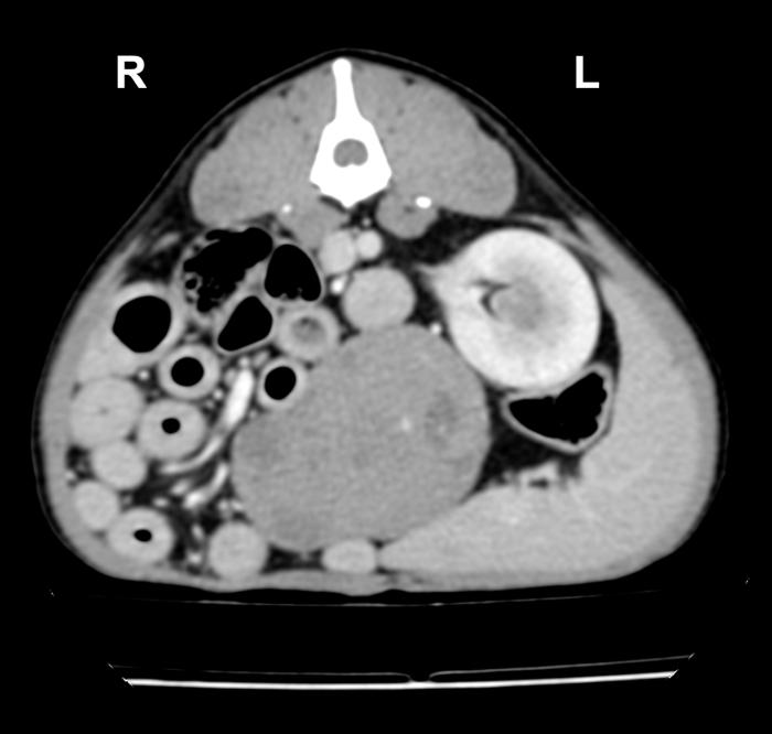 Figura 3. Imágenes en corte transversal (A) y (B) sagital del TC donde se observa la masa abdominal con origen del aspecto craneal y dorsal de la vejiga urinaria de hasta 4.8 cm de diámetro.
