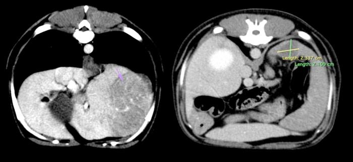 Figura 4. Estudio tomográfico del abdomen. Presencia de masa hepática localizada en lóbulo lateral izquierdo. Nódulo (hipoatenuado e hipocaptante) en la cabeza del bazo, con leve realce periférico.