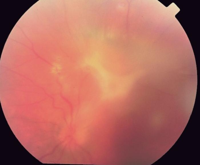 Figura 9. Fondo de ojo en paciente afectado por síndrome de larva migrans ocular. Granuloma por presencia de larvas de T. canis (imagen cortesía del Dr. Emilio Dodds).