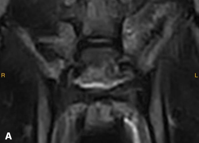 Figura 3. (A) Hiperintensidad de disco intersomático L7-S1 en RMN coronal FRFSE T2 y extensión a lateral izquierdo. (B) Hiperintensidad de disco intersomático L7-S1 en RMN sagital en STIR. (C) Hipointensidad de disco intersomático L7-S1 en RMN sagital T1. (D) Captación de contraste (Gadolinio) en RMN axial T1.