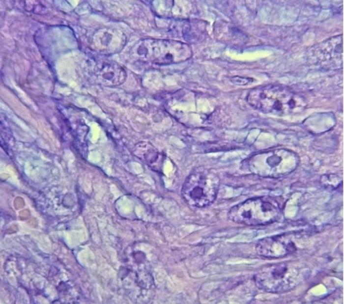 Imagen de corte histopatol&oacute;gico cedida por el doctor Federico Castro (pat&oacute;logo).