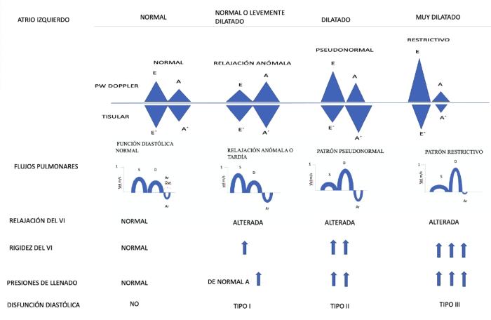 Figura 17. Clasificación de la disfunción diastólica con ecocardiografía, tamaño del atrio izquierdo, patrones del flujo transmitral con onda E y A, Flujo de las venas pulmonares con Ondas S y D y AR y con Doppler tisular del anillo mitral con ondas E’ y A’.