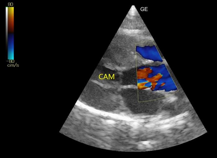 Figura 3. Corte paraesternal derecho, en eje largo, de cinco cámaras. Presencia de movimiento anterior sistólico de la cuerda tendinosa o CAM.