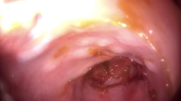Figura 1. Colitis granulomatosa en paciente canino, Bulldog francés de un año y medio, con diarreas crónicas y hematoquecia. Nótese la presencia de granulomas en mucosa intestinal. Imágenes obtenidas por colonoscopia (imagen cortesía del Dr. Nicolas Gariboldi).