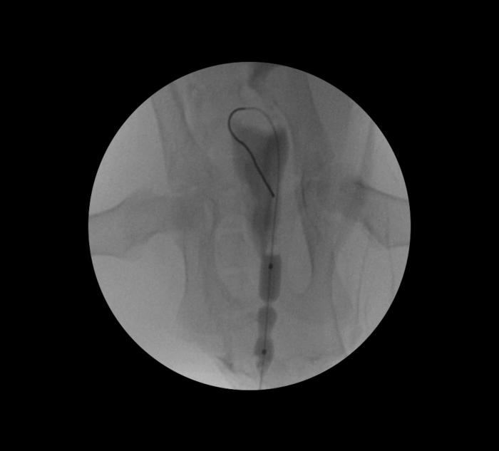 Figura 6. Manejo endoluminal de estenosis uretral en paciente felino. Proyección VD.