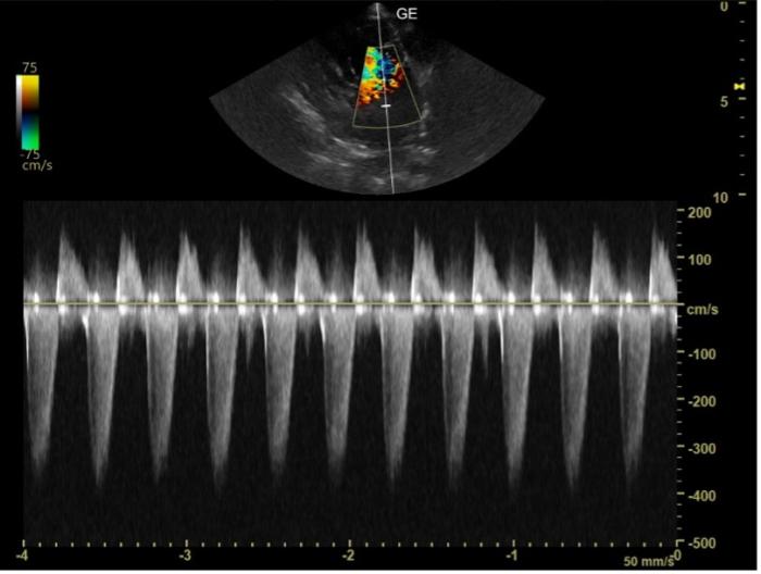 Figura 1. Imagen ecográfica obtenida mediante una proyección paraesternal izquierda apical de cuatro cámaras optimizada para la visualización del anillo mitral. Mediante el Doppler continuo (CW) se puede obtener la velocidad máxima de regurgitación a nivel de la válvula mitral (RM).