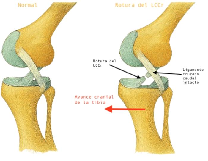 Figura 1. Comparación entre una articulación femorotibial sana y una con rotura del LCCr (elaboración propia).
