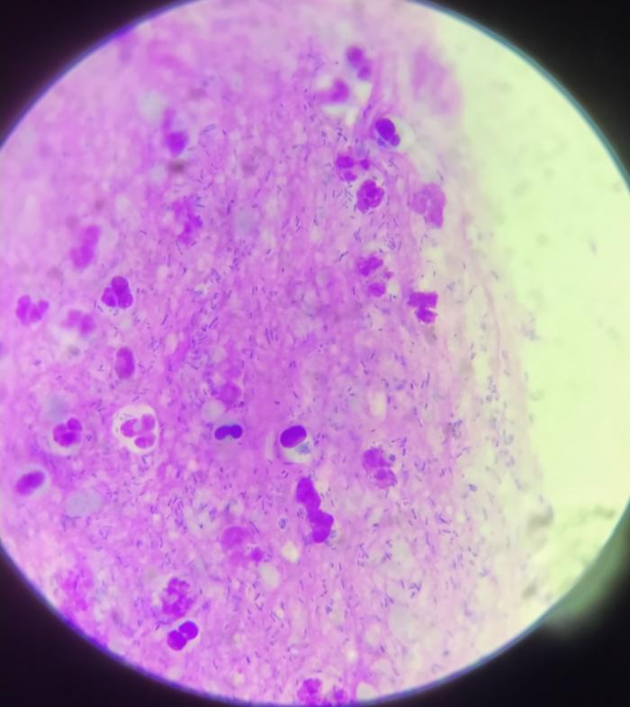 Figura 1. Biofilm en citología auricular. Obsérvese como las bacterias aparecen inmersas en una trama violácea proteica.