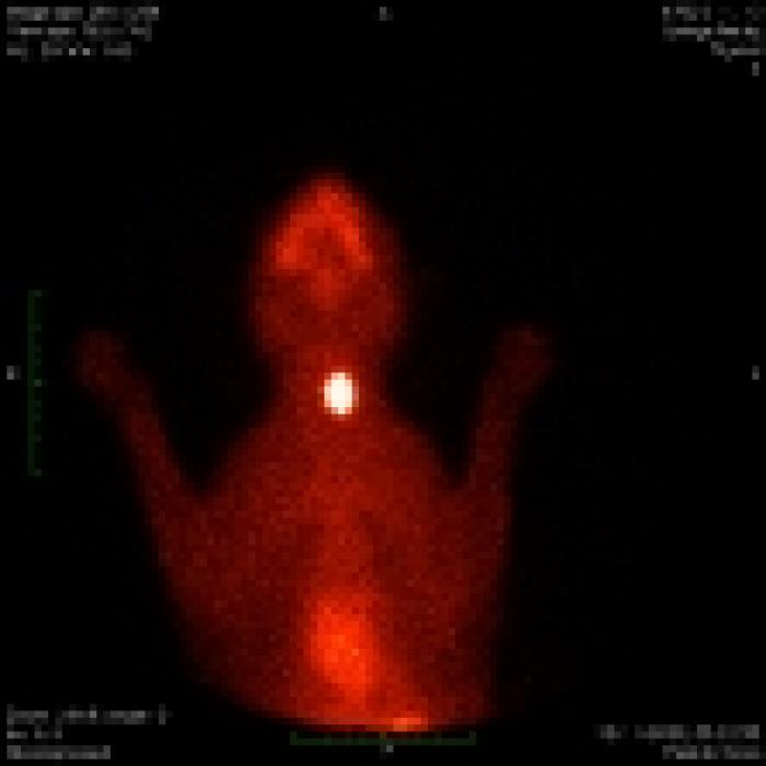 Figura 1 (A-D). Correlación entre la duración de la enfermedad, intensidad de los síntomas, valor de la T4 total y el volumen del tumor valorado con gammagrafía: (A) leve, (B) moderado, (C, D) severo.