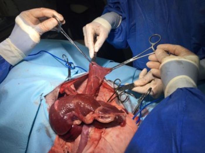 Figura 5. (A) Colgajo  de músculo dorsal ancho con pie vascular. (B) Colgajo muscular implantado por vía transtorácica en el defecto diafragmático. (C) Bolsa de Bogotá implantada para evitar hipertensión abdominal. (D) Cierre diferido de pared abdominal. Extraccion de bolsa de Bogotá.