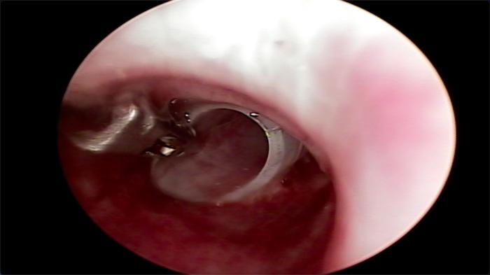 FIGURA 12. Visualización endoscópica de la colocación de un stent de silicona para el tratamiento de un colapso traqueal.