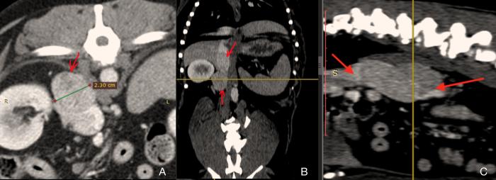 Figura 1. Imágenes de la TC abdominal (A) transversal, (B) dorsal y (C) parasagital donde se aprecia el tumor adrenal derecho con invasión severa (trombo tumoral) de la vena cava caudal.