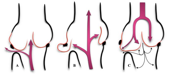 Adaptado de Yacoub et al. Anatomic correction of the syndrome of prolapsing right coronary aortic cusp, dilatation of sinus of valsalva, and ventricular septal defect. The Journal of Thoracic and Cardiovascular Surgery 1997;113:253-6117.