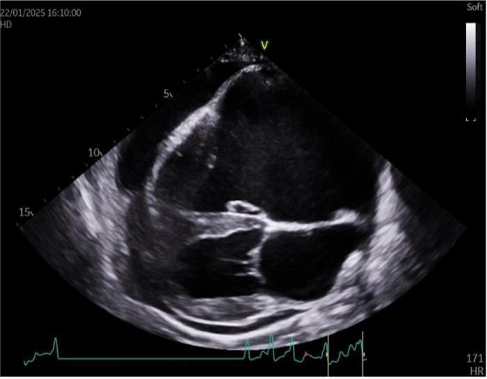 Figura 3. (A) Corte paraesternal derecho de cuatro cámaras en el que se aprecia la dilatación marcada de las cámaras cardíacas derechas y la presencia de derrame pericárdico. (B) Eje corte por a nivel de base cardíaca, este corte se realiza por ventana paraesternal derecha con un eje transversal. En esta imagen se puede apreciar la dilatación marcada de la aurícula derecha.