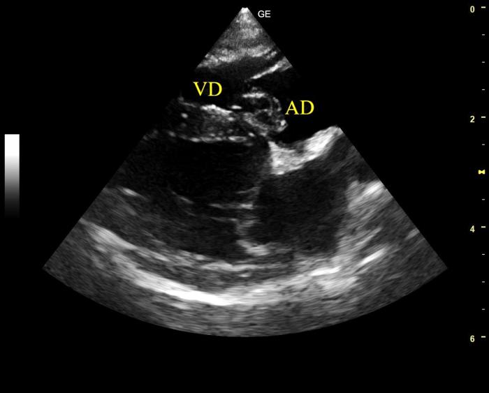 Figura 2. Corte paraesternal derecho eje largo 4 cámaras del caso 1 tras dos meses de terapia con sildenafilo, se observa una marcada reducción del tamaño del AD y una reversión parcial de la hipertrofia concéntrica del VD.