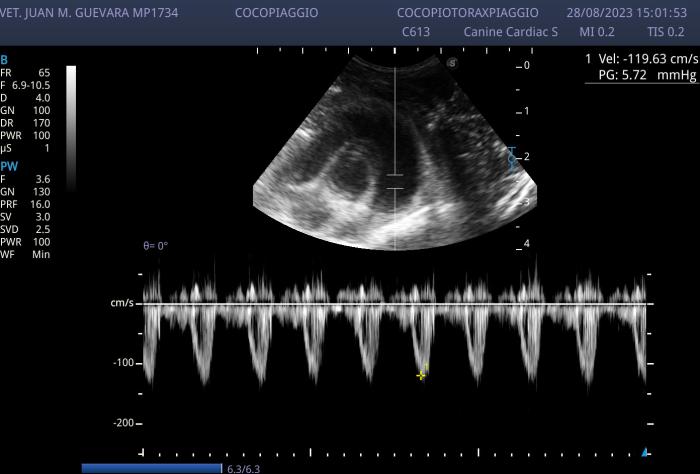 Figura 7. Control del flujo pulmonar con Doppler pulsado. En esta oportunidad se evidencia un perfil Doppler simétrico normal. Lo que sugiere normalización de la presión pulmonar.