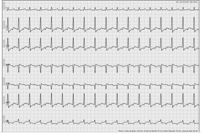 Figura 4. Electrocardiograma donde se registra ritmo sinusal con una frecuencia cardíaca de 190 lpm, eje eléctrico medio conservado y aplanamiento de onda p marcado (imagen cortesía del Dr. C. Daniel Rodríguez M.N. 9492).