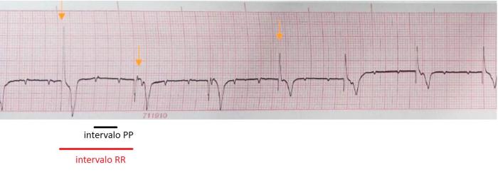 Figura 8. ECG en derivación II a 25 mm/s y 10 mm/mV. Se observan ondas P no conducidas, con una completa disociación del complejo QRS. La frecuencia atrial es de 150 lpm, mientras que la frecuencia ventricular es de 50 lpm. El ritmo de escape ventricular presenta polimorfismo (flechas naranjas señalan las 3 morfologías diferentes identificadas).