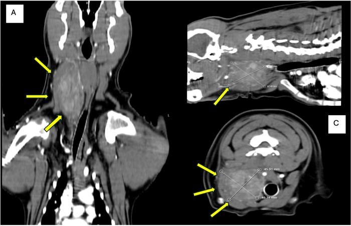 Figura 2. Reconstrucción multiplanar de imágenes poscontraste de tomografía computarizada que muestra una masa de tejido blando de forma irregular, con realce de contraste heterogéneo, en la región cervical derecha (flechas). (A) Vista dorsal. (B) Vista sagital. (C) Vista transversal (gentileza Mv Ezequiel Marini, Córdoba, Argentina).