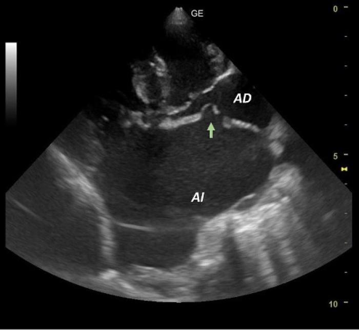 Figura 8. Imagen ecográfica obtenida mediante una proyección paraesternal derecha en eje largo de cuatro cámaras donde puede visualizarse un defecto en el septo interatrial a nivel del foramen oval de 6.4 mm (flecha verde). 