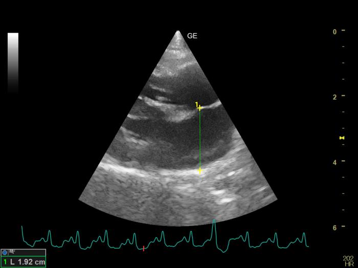 Figura 8. Corte paraesternal derecho en eje largo de 4 cámaras. Medida del diámetro del atrio izquierdo (LAD) en telesístole. Se observa una extrasístole ventricular en el 7º complejo del electrocardiograma.