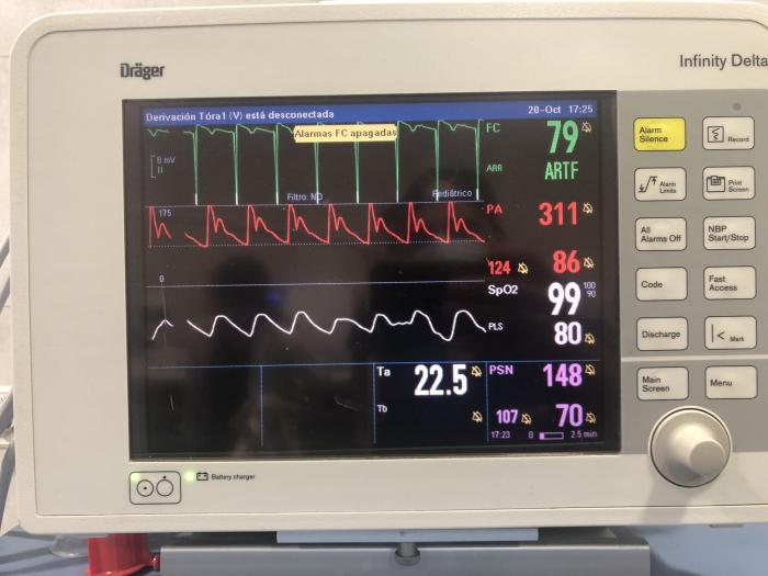 Figura 3. Imagen de la monitorización de la presión arterial invasiva (en rojo) y no invasiva (en rosa) durante la anestesia en la que se aprecia la diferencia entre ambas. En el electrocardiograma se pueden observar los complejos generados por el marcapasos externo.