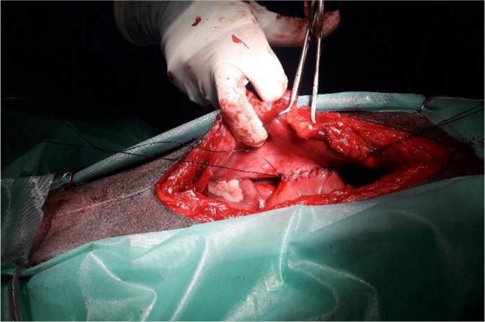 Figura 9. Imagen intraquirúrgica de realización de la gastropexia. Unión de las incisiones en pared gástrica y abdominal con sutura monofilamento reabsorbible (polidioxanona) realizando un patrón simple continuo monocapa. Se coloca un punto inicial que aproxime el estómago a la pared abdominal, y a su vez se mantienen los cabos largos, sujetos con una pinza vascular (mosquito), que nos permiten traccionar y exponer mejor la zona a suturar.