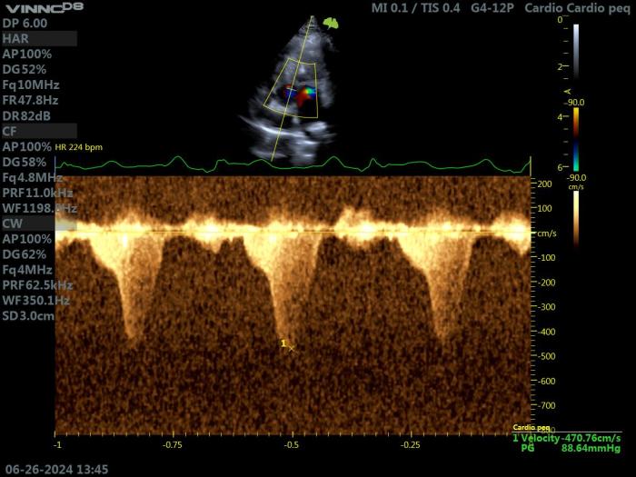 Figura 11. Ecocardiografía Doppler en un gato con HCM obstructiva. Proyección paraesternal izquierda apical 5 cámaras. Doppler continuo que muestra un flujo transaórtico turbulento de alta velocidad, con un perfil asimétrico típico de obstrucción dinámica.