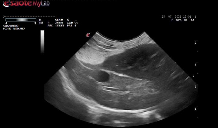 Figura 7. Diferencia ecográfica del lóbulo hepático derecho normal y el izquierdo torsionado, con patrón hipoecogénico muy marcado.